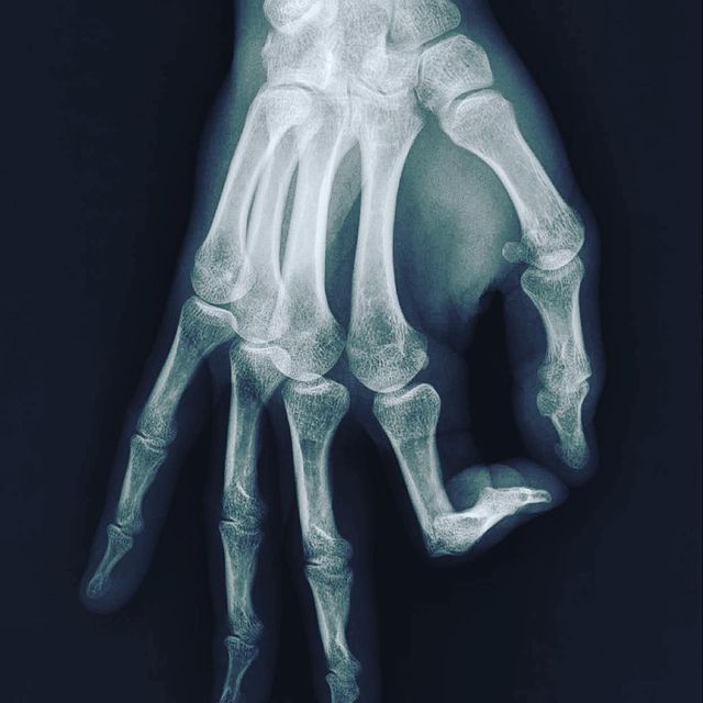 JACQUELIN Emilien, - Comment ça va Emil?
- moi : 👌🏻😂
Petite fracture de l’os crochu. Heureusement peu de douleurs, l’entraînement continue mais en faisant attention. Écouter son corps, la base pour être performant ✌️😁